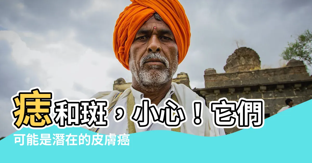 【痣 斑】痣和斑，小心！它們可能是潛在的皮膚癌徵兆